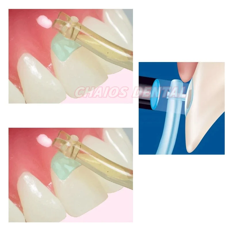 Original Kerr Dental Hawe Transparent Cervical Matrices Assorted Kit NO.850s Kerr Hawe Matrix Composite Gingival Shape Resin