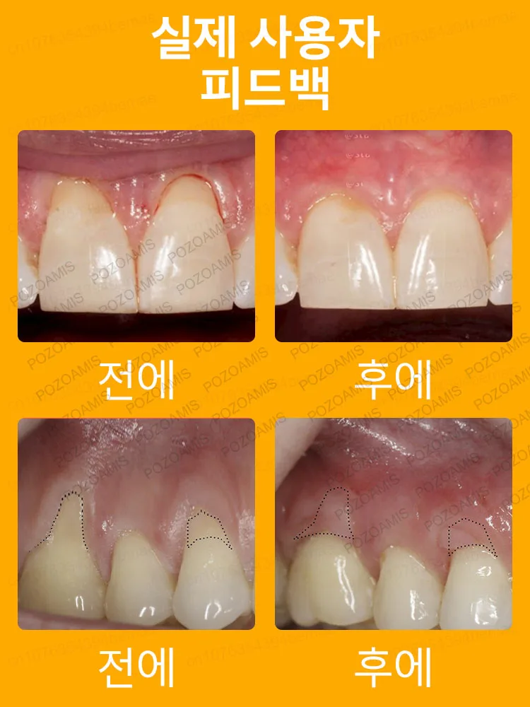 치통을 즉시 제거하고 치주염을 빠르게 해결합니다.