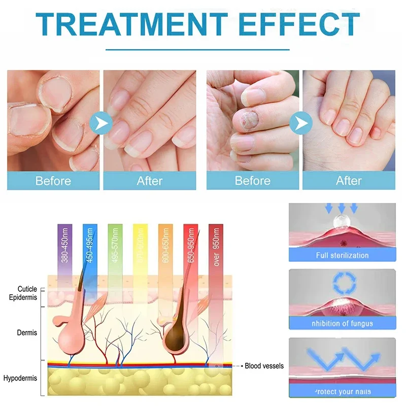 Dispositivo de tratamiento láser para hongos en las uñas, tratamiento de hongos, esencia para el cuidado de los pies, antiinfección, paroniquia,