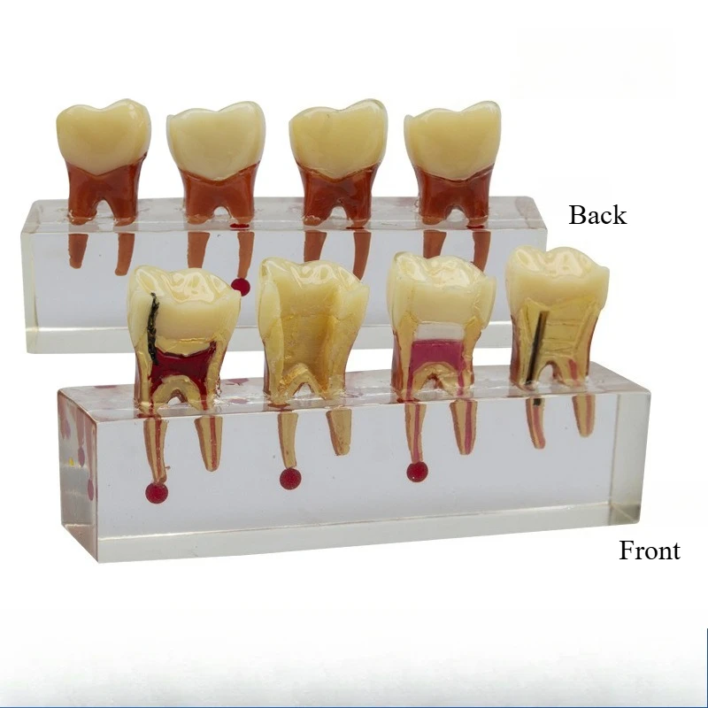 Dental Educational Model for Communication and Demonstration: Pediatric Model Featuring Primary Teeth Cavities and Pulp Repair