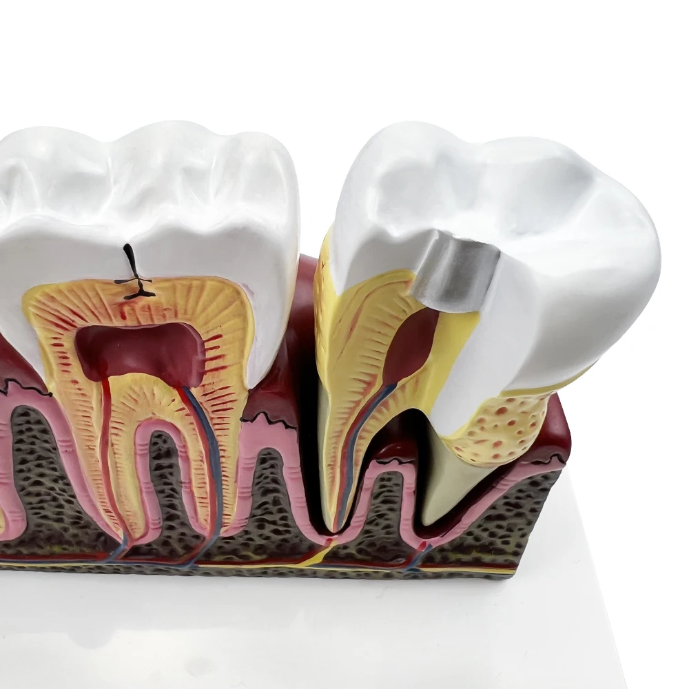 Patologie stomatologiczne anatomiczny Model struktury do nauczania badania leczenia kanałowego demonstracyjna dentysta dla pacjenta