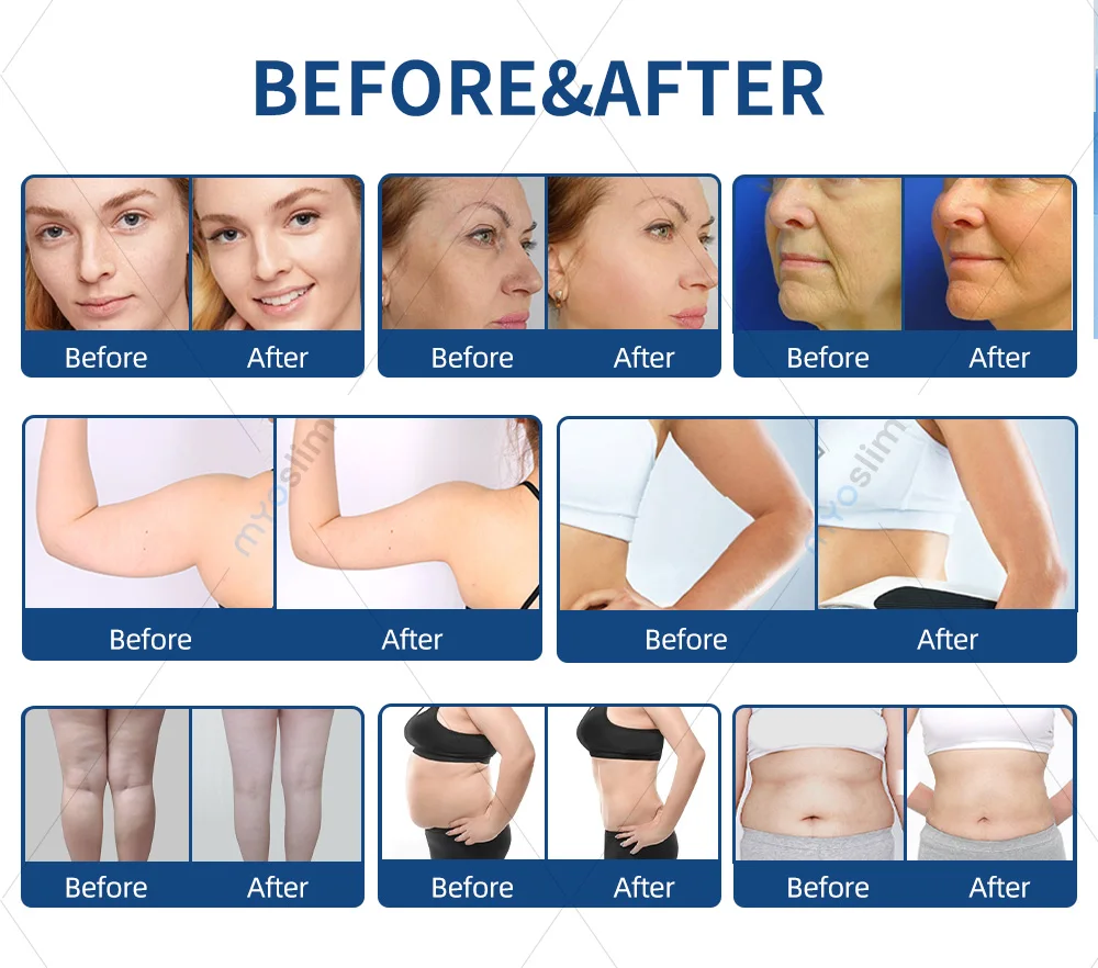 

980 Diode Laser Slimming 1470 Lipolysis Laser Fat Reduction Face Lifting Endo lifting Laser Lipo Suction Machine