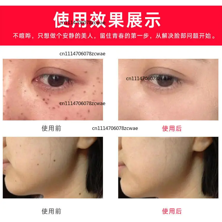 ZOCI-FOR Portable Blue Light Beauty Pen for Home Facial Skin Care, Skin Spot Mole Removing Beauty Device