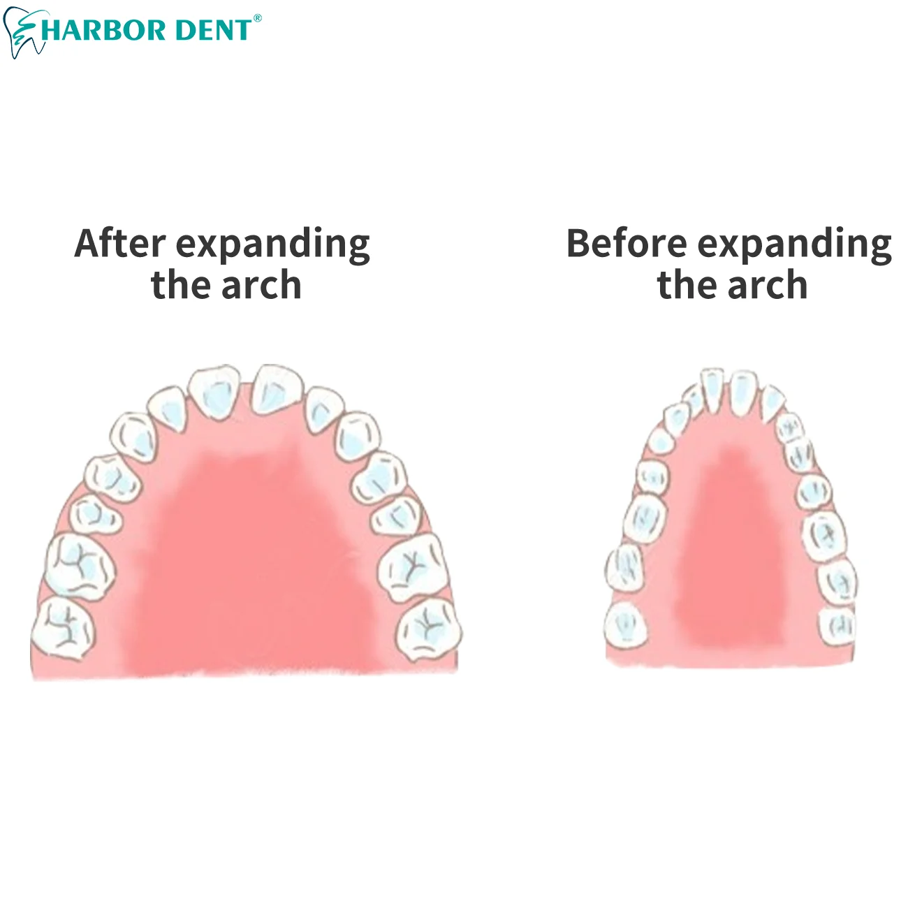 Dental Orthodontic Expansion Screw Stainless Steel Rapid Palatal Expander Frame Type Micro Standard 8/ 9/13mm Dentistry Tools