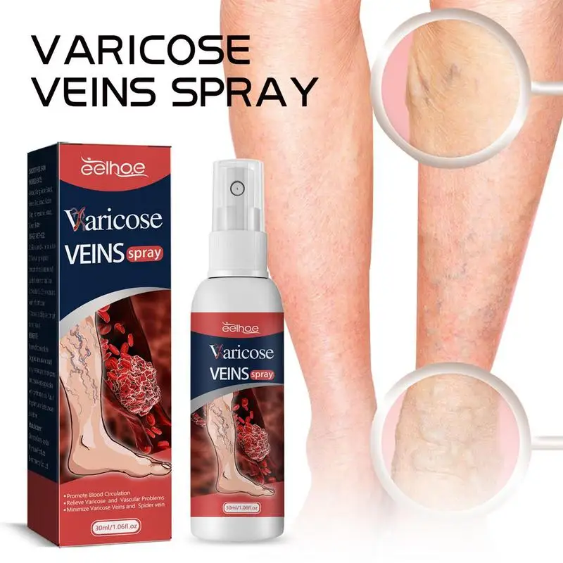 30ml Varicose Vein Spray Vasculitis Phlebitis Relief Spray Spider Legs Earthworm Legs Treat Spray Swelling Discomfort Body Care