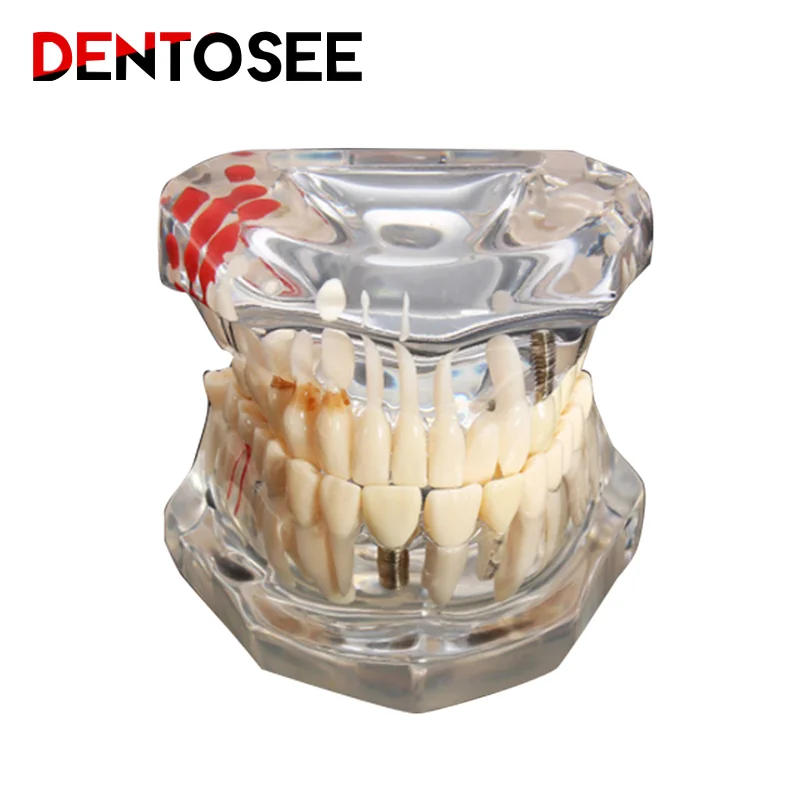 Dental Model Teeth Implant Restoration Bridge Teaching Study Medical Science Disease Dentist Dentistry Products