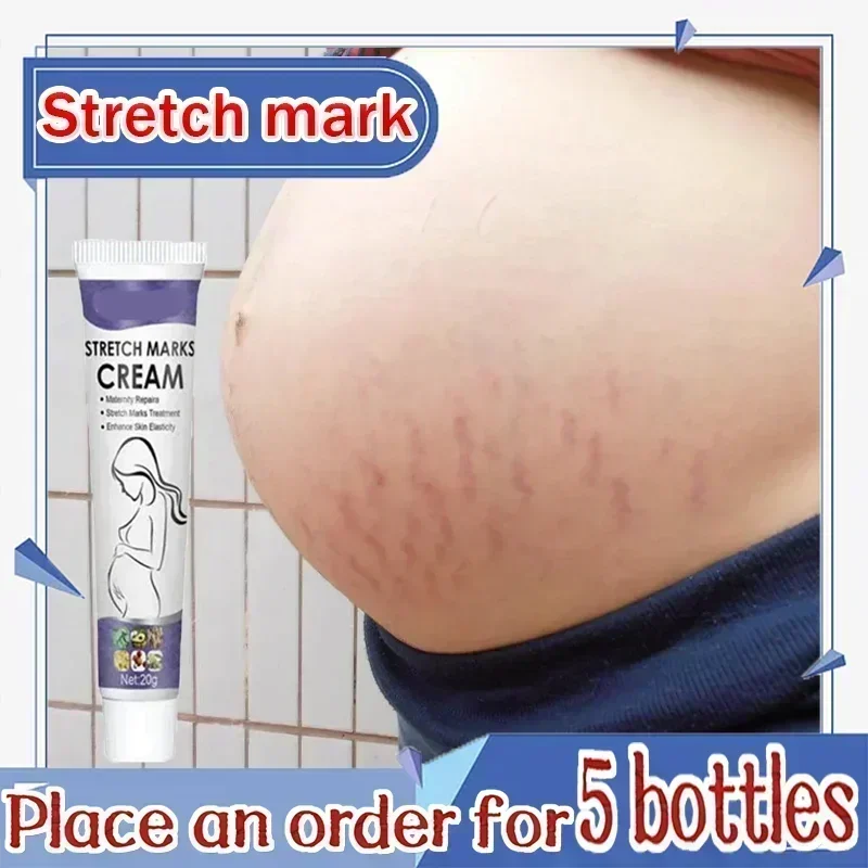 เจลบำรุงผิวกำจัด krim stretch Mark แดงขาวเก่าสำหรับการตั้งครรภ์หลังคลอด