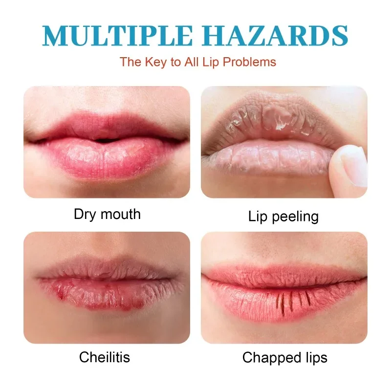 Cold Sores Lip Cheilitis Treatment Cream Herpes Antibacterials Ointment Chapped exfoliating fade Lip line moisturizing care balm