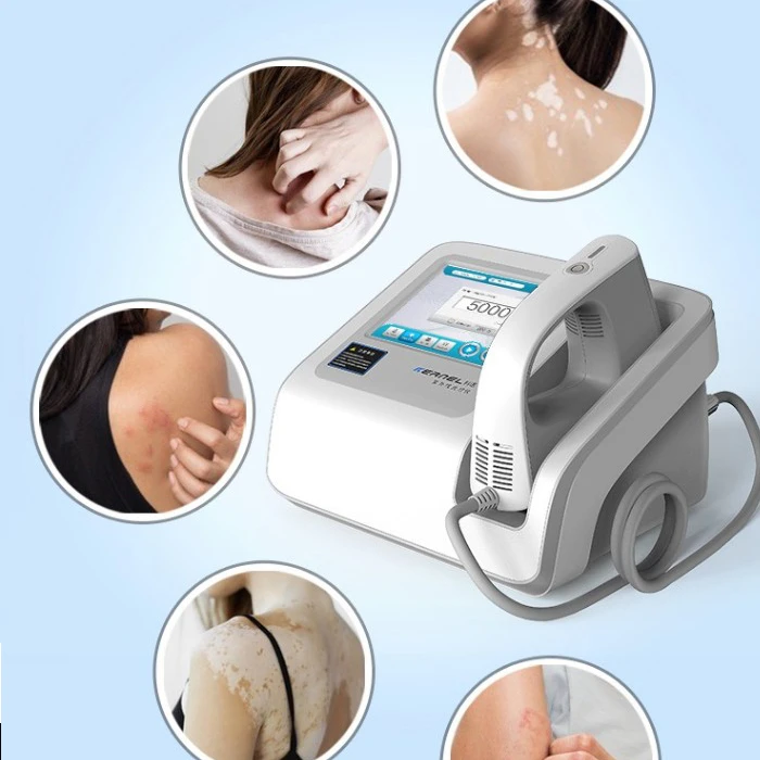 Uv308 Phototherapy Excimer Laser Light Phototherapy to Regulate Excessive Immune System Activity for Psoriasis Vitiligo