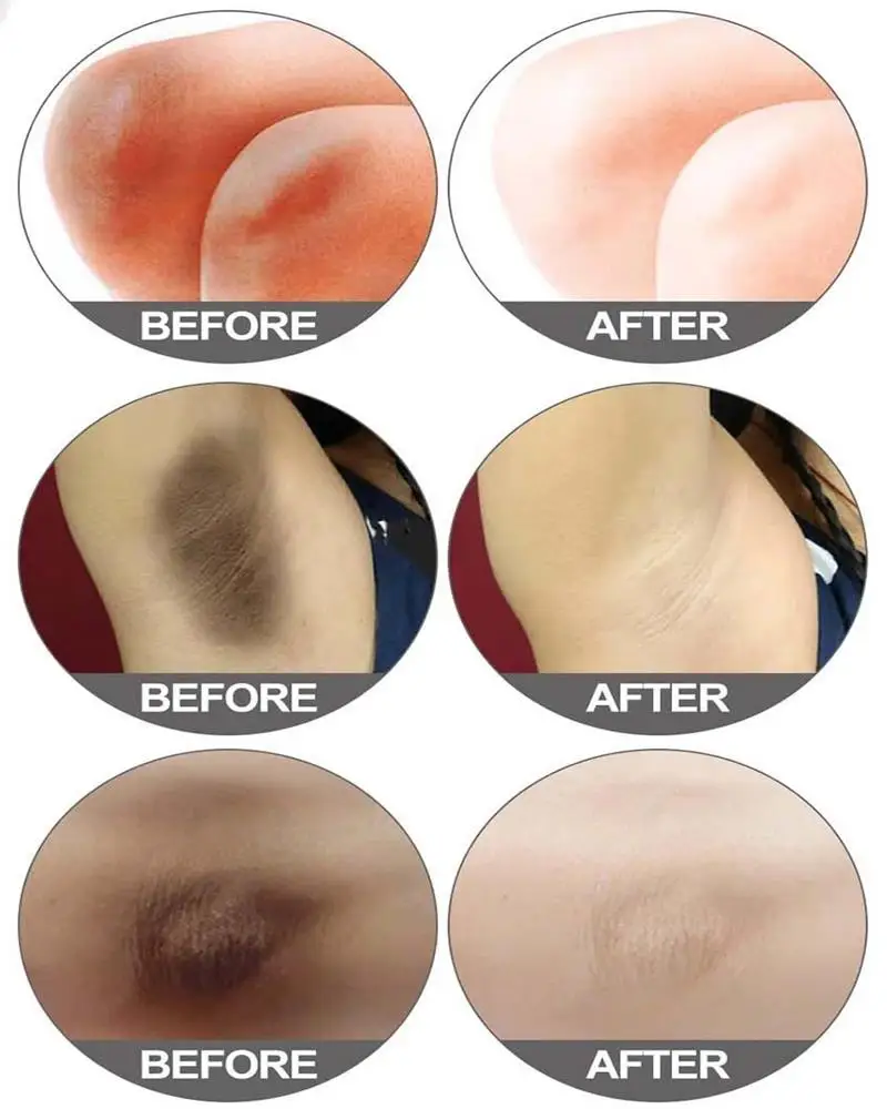 كريم تبييض للبشرة الداكنة تحت الإبط تبييض الإبط تفتيح المنطقة الحميمة مرطب امرأة منتجات العناية بالبشرة الكورية