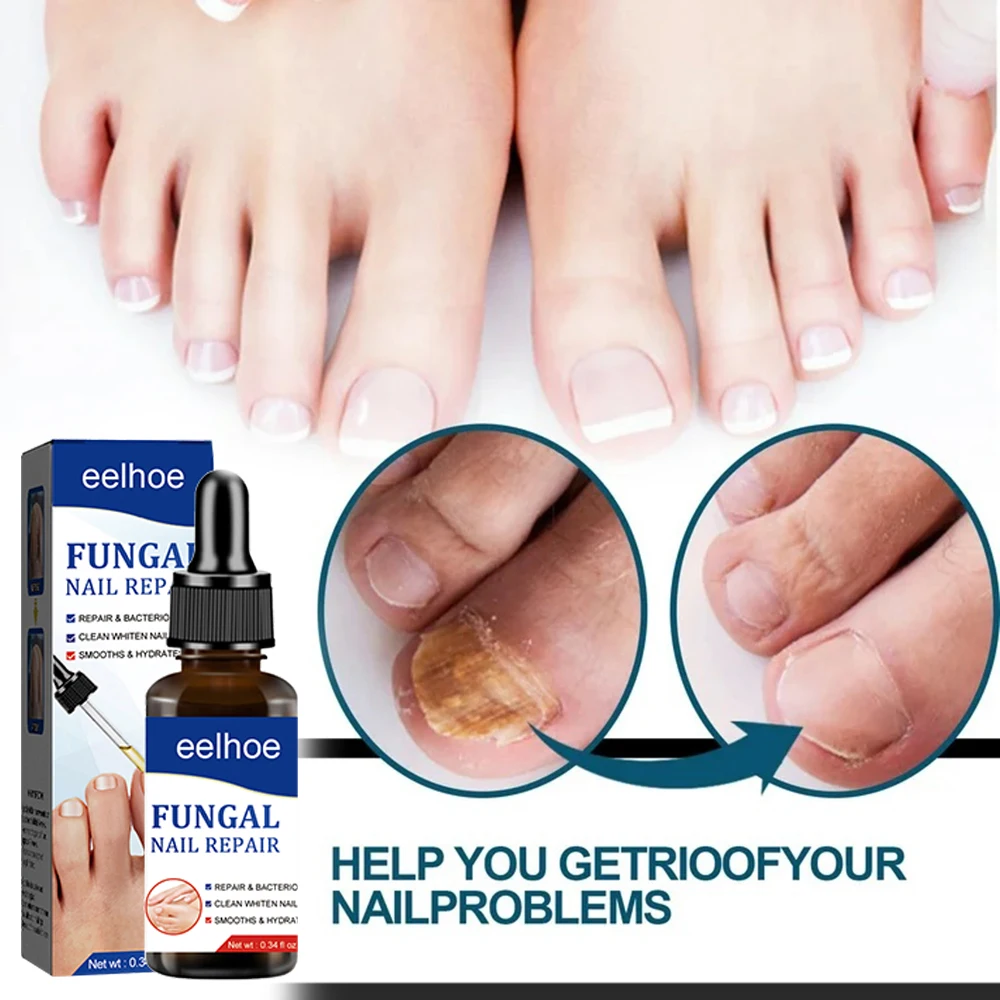 Verwijder nagel schimmel serum voetverzorging
