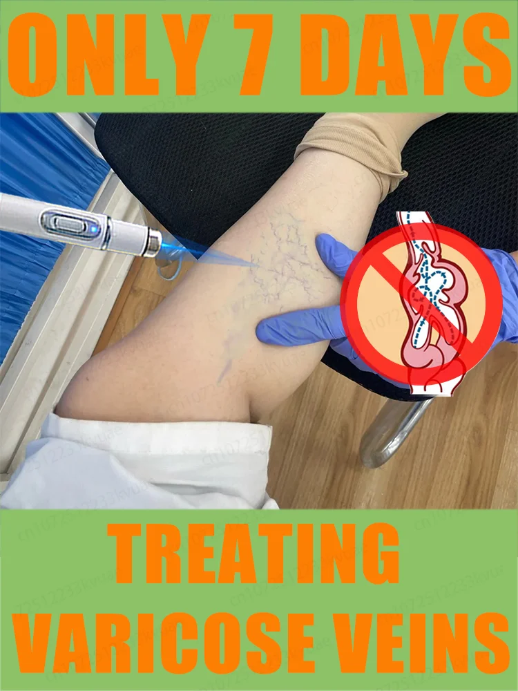 قلم الضوء الأزرق يحل الدوالي، أدوات العناية بالساق رائجة البيع تزيل الساقين العنكبوتية خلال 7 أيام