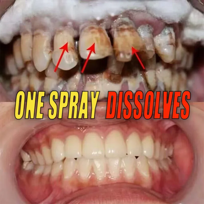 

Effectively Removes Yellow Teeth Calculus Plaque Stains Dental Recommend