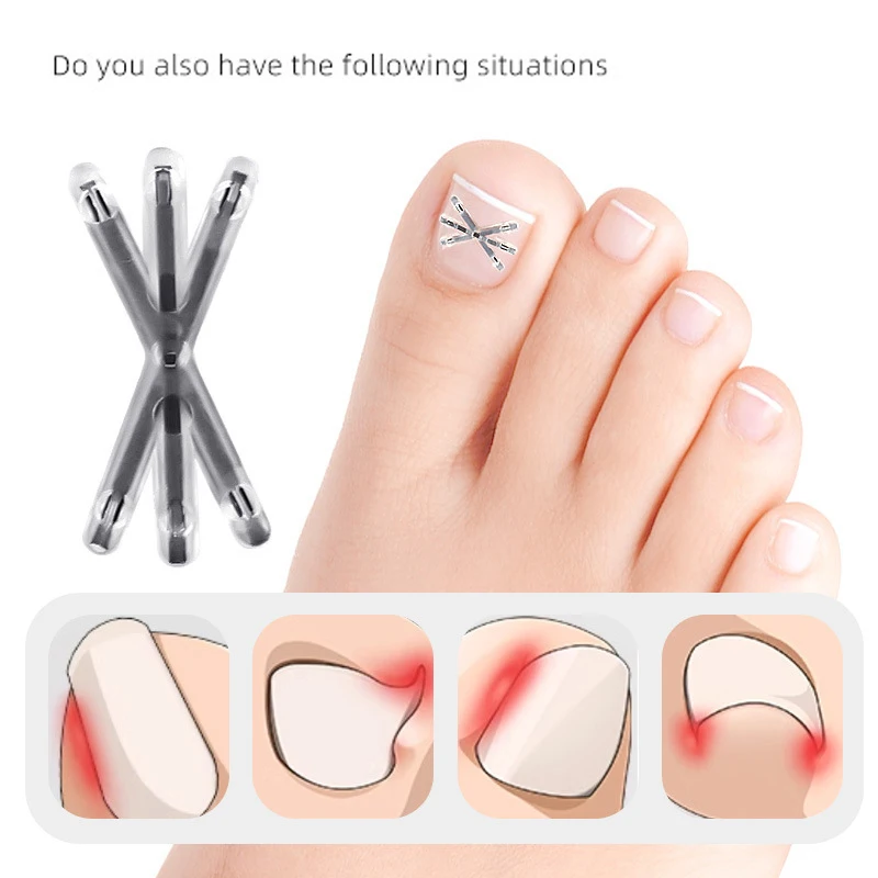 2 Pcs Ingrown Toenail Correction Tool Set with Elastic Patch Sticker Pedicure Tools for Toenail Straightening And Treatment