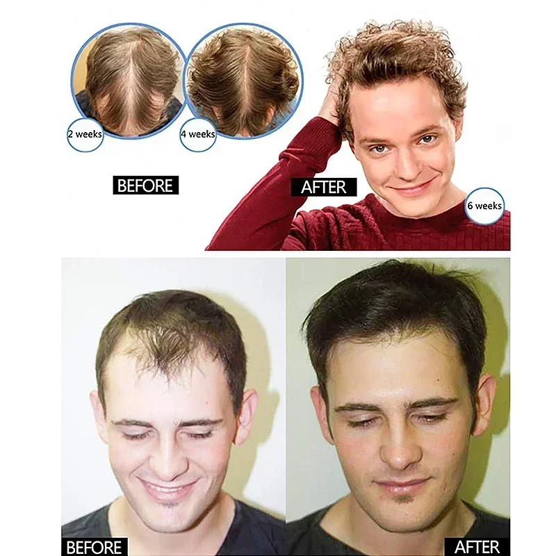 Óleo de crescimento de cabelo para homens e mulheres, crescimento rápido do cabelo, anti perda de cabelo, tratamento do couro cabeludo, produtos de soro, beleza, 2024