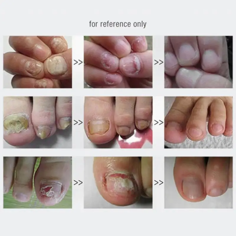 Toe Nail Fungus Remover Fast Acting Revolutionary Nail Fungus For Men Anti Nail Fungus Cure Popular Powerful