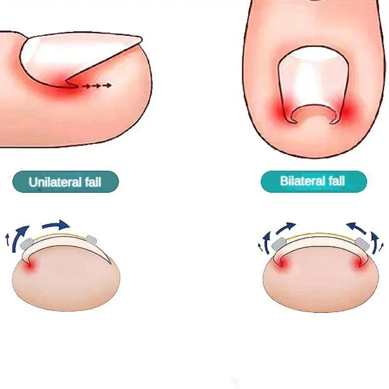 Herramientas correctoras de uñas encarnadas, tratamiento profesional de pedicura, corrección de uñas encarnadas