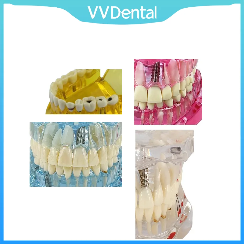 

VVDental Repairable Resin Diseased Teeth Models – Realistic Dental Disease Simulators for Medical & Dental Education & Research