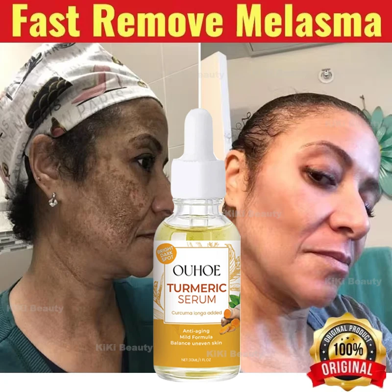 

Dark Spots Remover Whitening Serum Turmeric Face Freckle Melanin Correcting Anti Pigmentation Brighten Beauty Skin Care Products