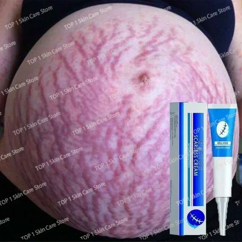 Eliminate Red White Old Stretch Marks Cream For Pregnancy Postpartum Skin Care 1006