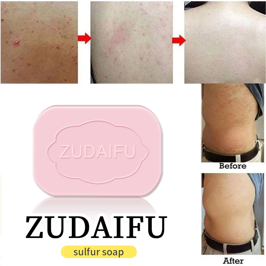 3Pcs ZUDAIFU Sulfur Soap Removal Pimple Acne Skin Conditions Perfume Bath Oil Control Health Care Soap 80g