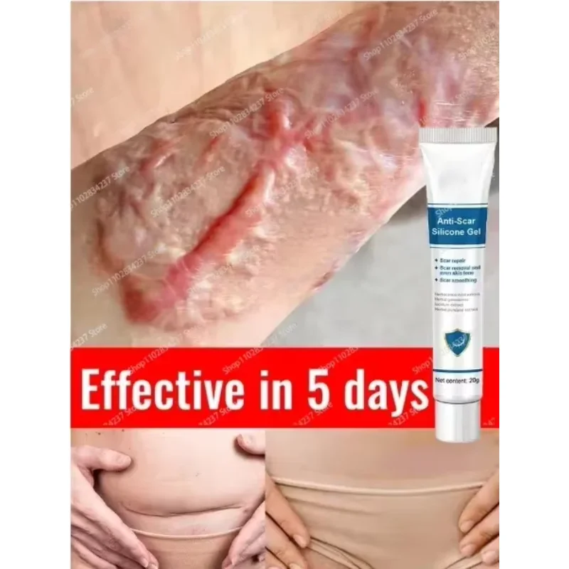 

Eliminate Red White Old Stretch Marks Cream For Pregnancy Postpartum Skin Care Gel New