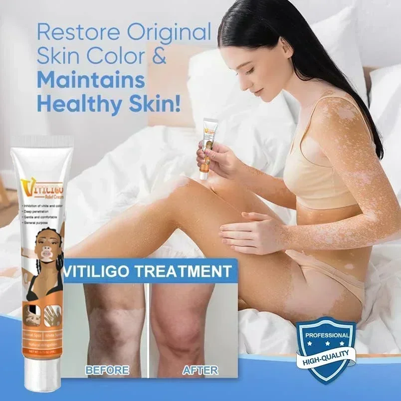 Sdotter New Vitiligo Treatment for Skin Vitiligo, Vitiligo Care  for Reduce White Spots and Improve Skin Pigmentation0903