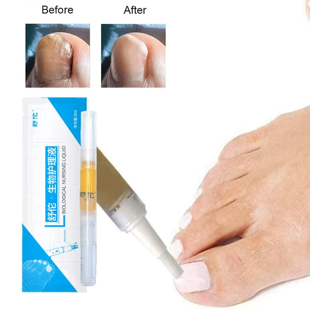 7DAYS Nail Fungus Treatment Essence Serum Care Hand Anti-infective And Gel Nail Repair Care Removal 3ml Gel Removal Foot Fu D5H3