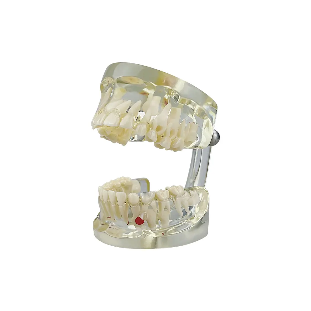 Dental Teaching Model Child Primary Teeth Mixed Dentition Model With Pathology Caries Dentistry Dentist Studying Pediatric Model