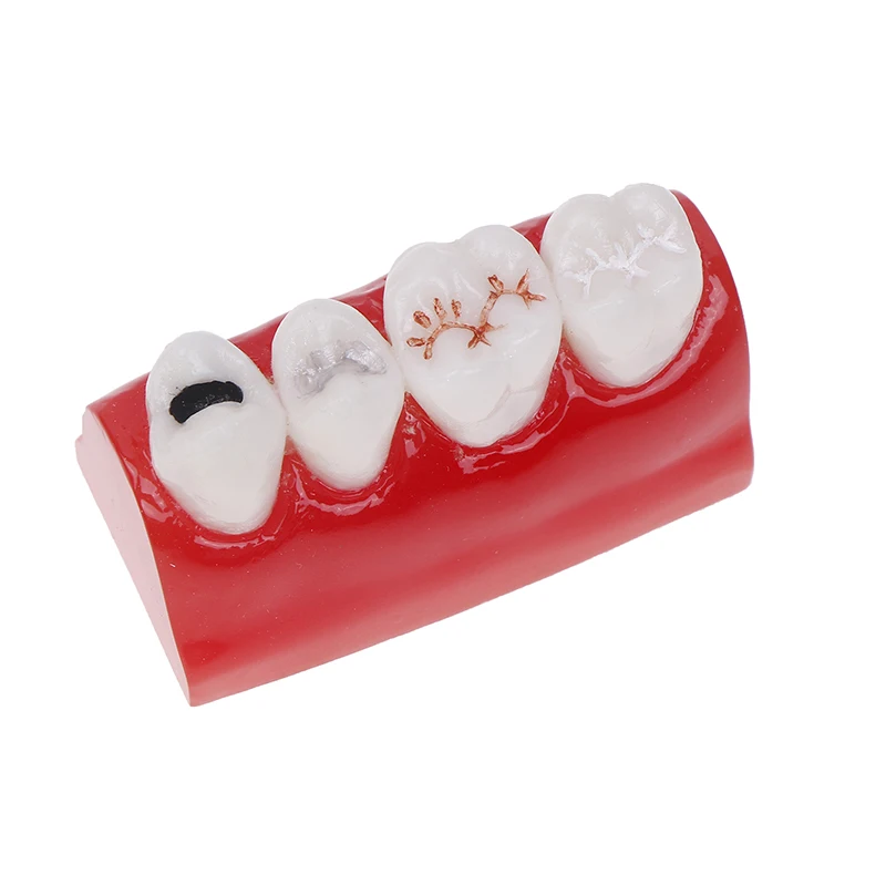 Dental Resources Sealants Demonstration Dental Study Model Dental Pit And Fissure Closed Model Treatment Teeth Model