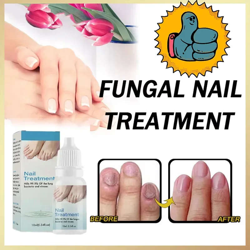 Fungal Nail Treatment Oil Foot Repair Essence Toe Nail Fungus Removal Gel Anti Infection Cream Fungal Nail Removal 10ML