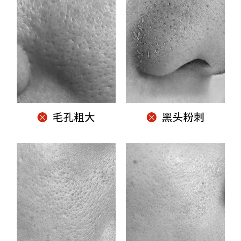 Bamboe Houtskool Zuig Mee-eter Gezichtsmasker Crème Om Mee-eter Acne Porie Tear Type Neusmasker Neuspleister Voor Mannen Vrouwen