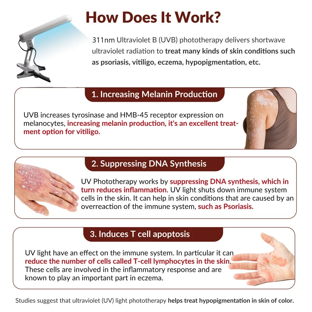 

311NM UVB Phototherapy Lamp Device for Vitiligo Treatment UV NarrowBand Ultraviolet Light Therapy Psoriasis Spots