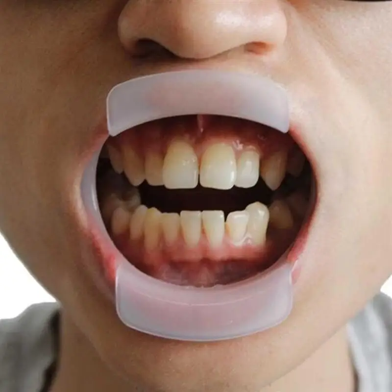 1 Stück Dentaler O-förmiger Intraoraler Lippen- und Wangenretraktor Mundöffner für Mundhygiene Zahnaufhellung Expander Kieferorthopädische Hilfsmittel