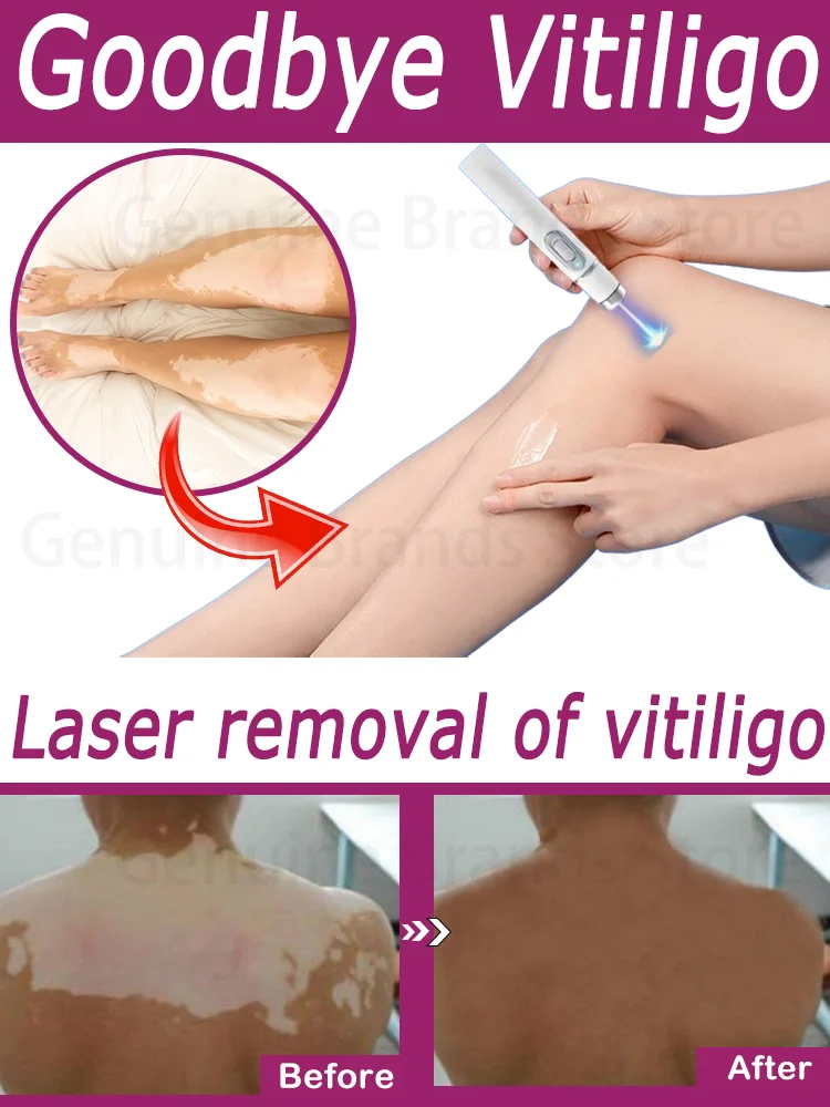 Laser w długopisie Vitiligo z niebieskim światłem