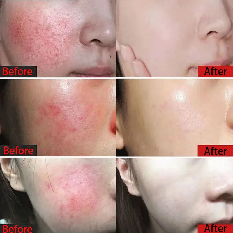 Facial Redness Repair Cream Improve Sensitive Skin Redness Rosacea Itching Instant Spider Vein Treatment Anti Aging Skin Care