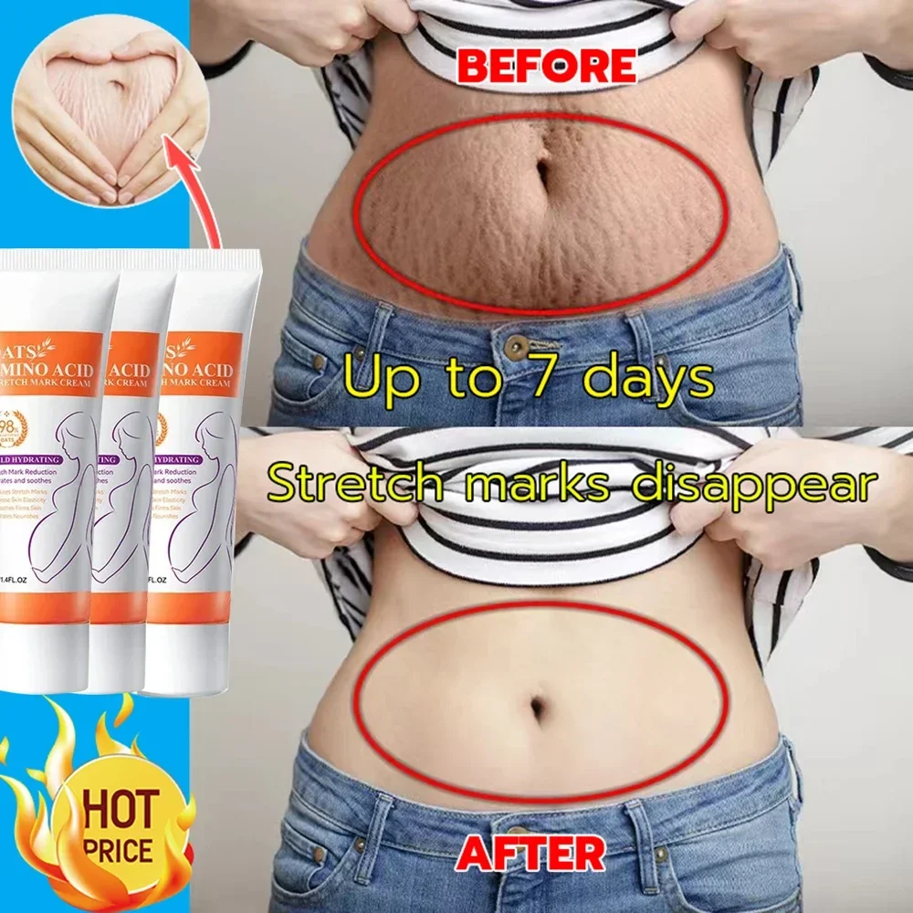 Krim penghilang Stretch mark, krim penghilang permanen menghilangkan Stretch mark perut Tubuh tanda bengkak menghilangkan kulit pecah-pecah Perawatan Pengencang