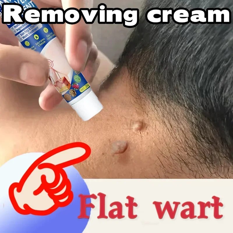 

Filamentous warts are specially used to paste flat warts on the neck especially small meat granules a touch of medicine