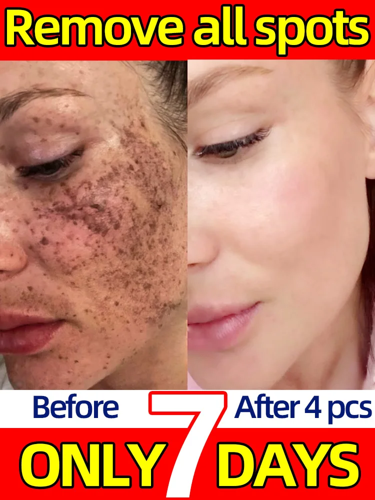 

Freckles Cream Remove Dark Spot