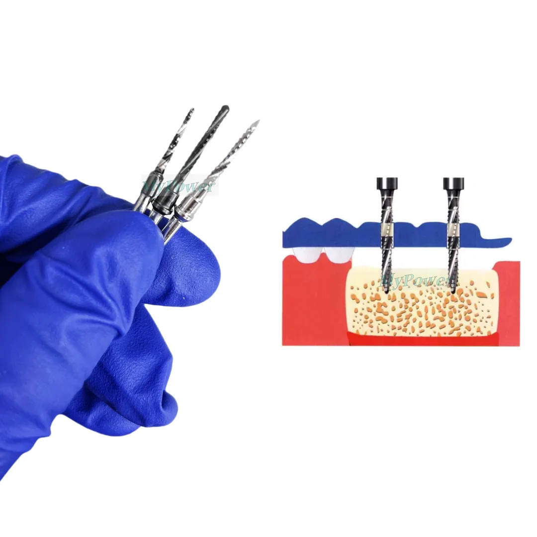 Broca de implante dentário transversal, corte do osso, lâmina de Debre Fit, Lindemann Osstem 2.3, 2.0, M1.8