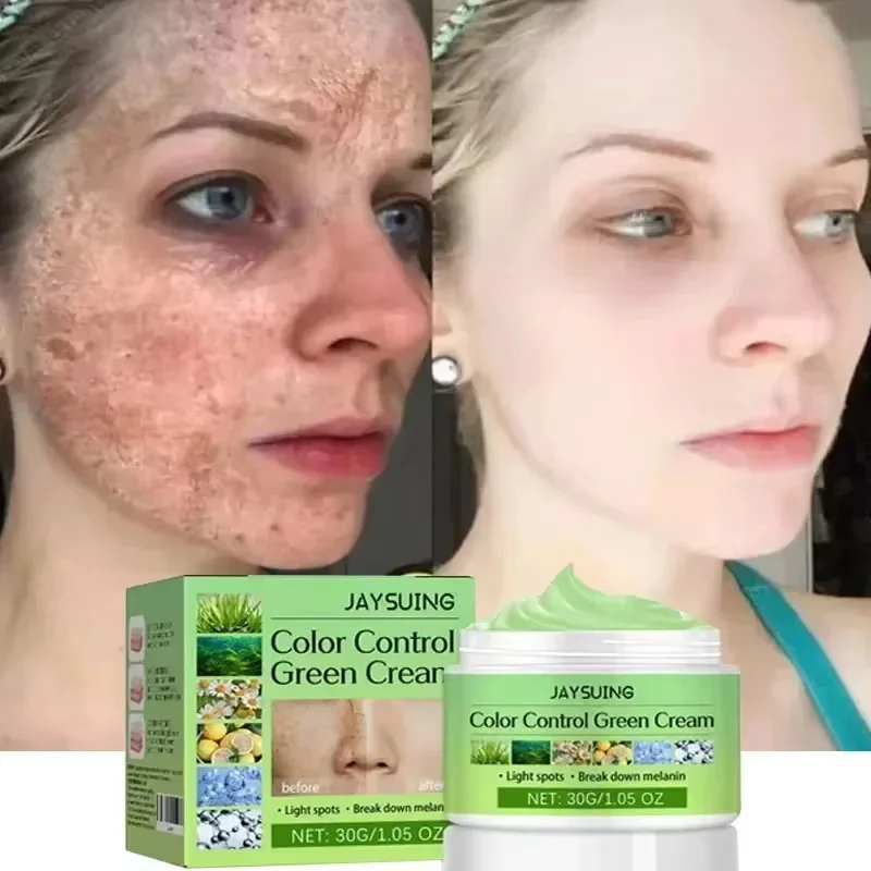 

Whitening Freckle Face Cream Remove Melasma Dark Spot Lightening Melanin Brightening Melasma Anti-Aging Skin Care Beauty Product