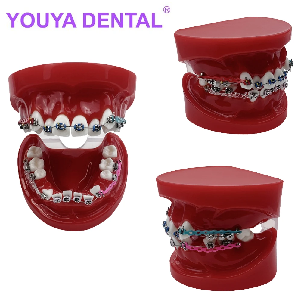 

Orthodontic Dental Model With Metal Bracket Resin Typodont Ortho Treatment Model Dentist Tooth Teaching Model With Ligature Ties