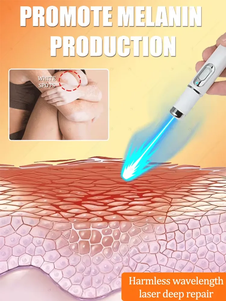 Generation-2 Laser Says Goodbye To Vitiligo In 7 Daysa