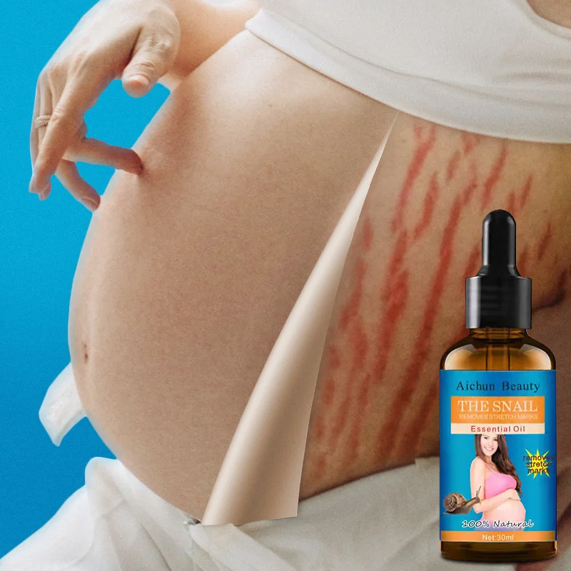 Natural Removal Pregnancy Essential Oils Prevent Stretch Marks From Growing Postpartum Repair Fade Abdominal Scars Firm Skin