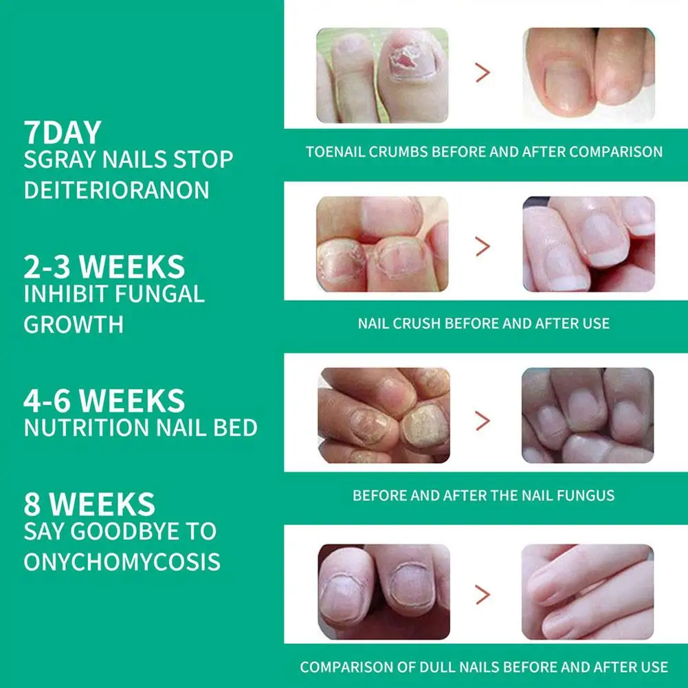 Nail Fungus Tratamento Soro, Óleo de Essência, Reparação Care, Anti Toe Gel Infecção, Pés Creme, Unhas Remoção, Fungo, Extra Forte