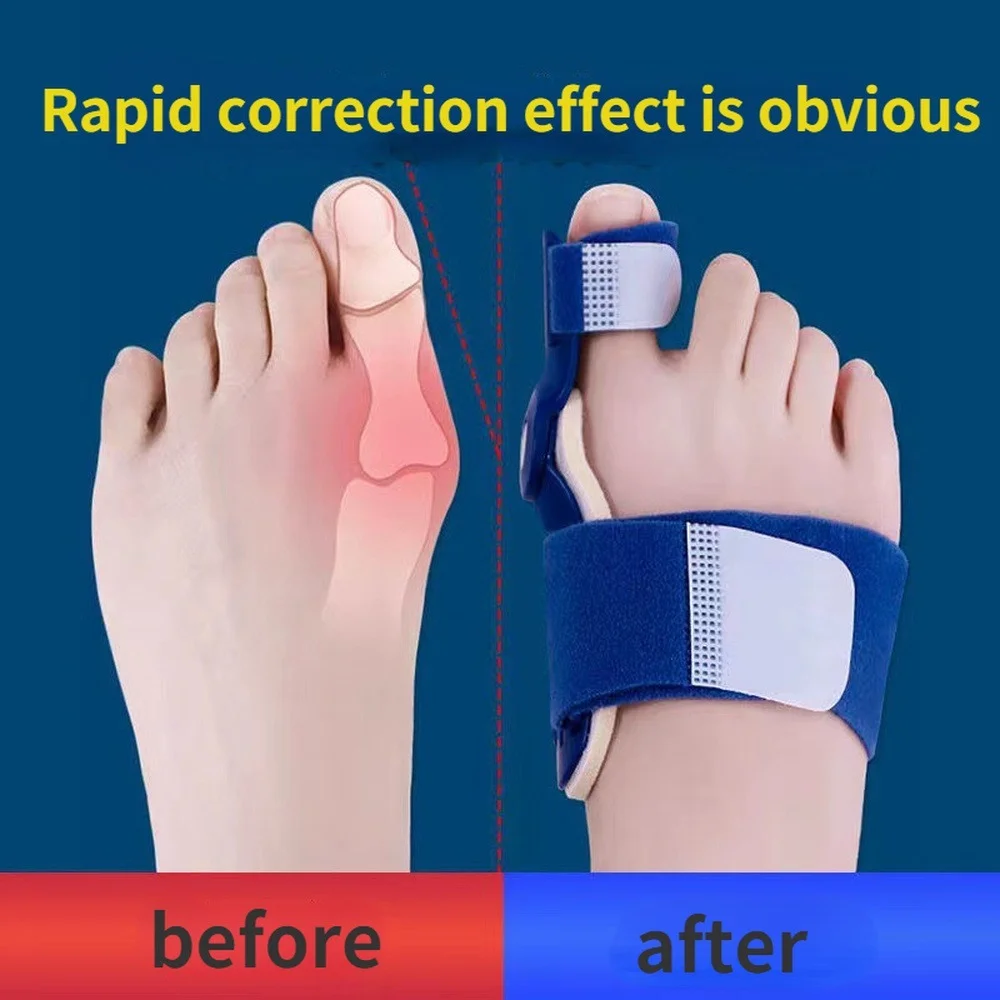 1Pcs Bunion Corrector Hallux Valgus Corrector Bunions for Toes Corrector Foot Finger Separator Toe Separator Foot Care Haluksy