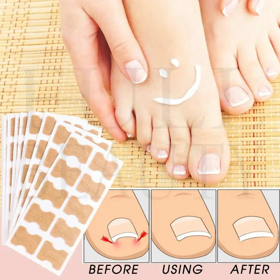 คุด Toenail Correction สติกเกอร์กาว Toenail Patch ยืดหยุ่นเล็บ Corrector สติกเกอร์ Foot Care เครื่องมือ