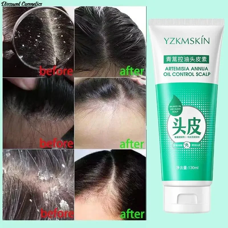 120ml Scalp Cleansing Shampoo Dandruff Seborrheic Follicles Antibacterial Anti-itching Mites Oil Control Psoriasis Removal Acne