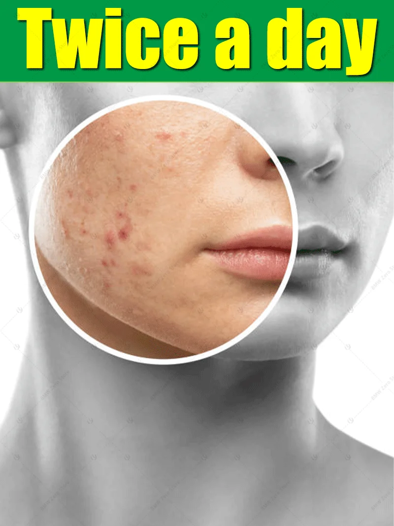 

Acid Acne Removal Cream Anti-Acne Repair Redness Pimple Spots Deep Cleaning Pore Oil Control Moisturizing Skin Care