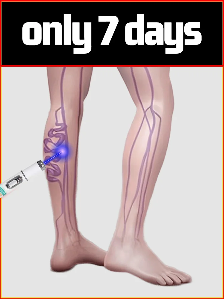 Stylo à lumière bleue pour sauver les varices, les jambes d'araignée en 7 jours pour hommes, femmes, toutes personnes